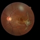 Juxtafoveal Choroidal Neovascularization Secondary to Choroidal Rupture Juxtafoveal Choroidal Neovascularization Secondary to Choroidal Rupture